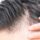 Follicular Unit Extraction (FUE) Hair Transplantation